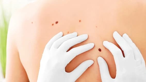 A doctor examining moles on a patient's back