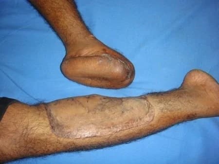 Lower-limb flap reconstruction, After healing