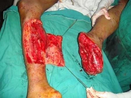 Lower-limb flap reconstruction, During surgery