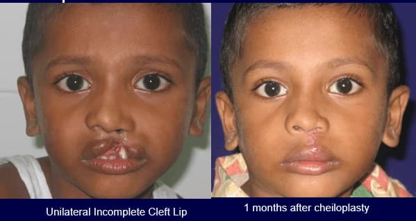 Unilateral incomplete cleft lip, Before · 1 month after cheiloplasty