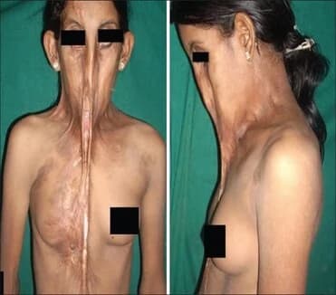 Burn contracture release, Before · After