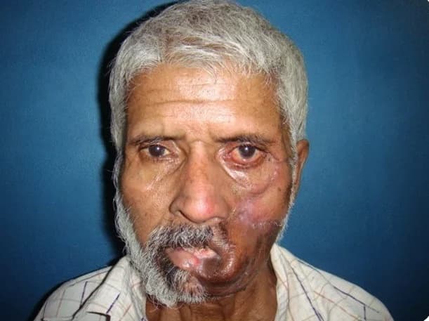 Lip and cheek tumour: excision and reconstruction, after