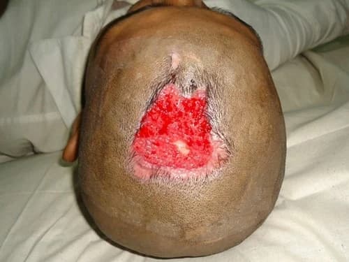 Scalp reconstruction, before