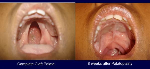 Complete cleft palate: palatoplasty, Complete cleft palate · 8 weeks after palatoplasty
