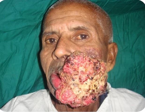 Lip and cheek tumour: excision and reconstruction, before