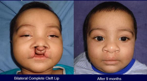 Bilateral complete cleft lip repair, Before · 9 months after