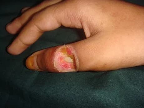 Finger reconstruction, before