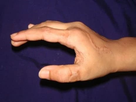 Finger reconstruction, after