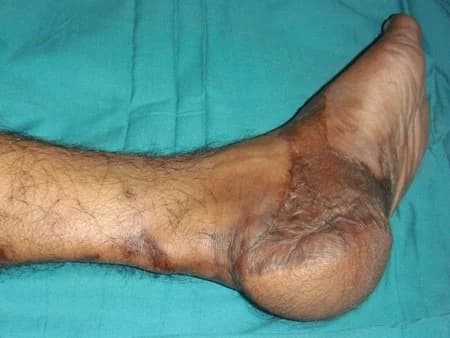 Heel healed after island flap reconstruction