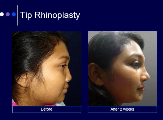 Tip rhinoplasty before and after