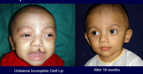 Unilateral incomplete cleft lip, 18 months on, Before · 18 months after