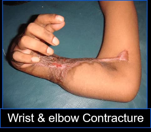 Forearm cover with an abdominal flap, Before