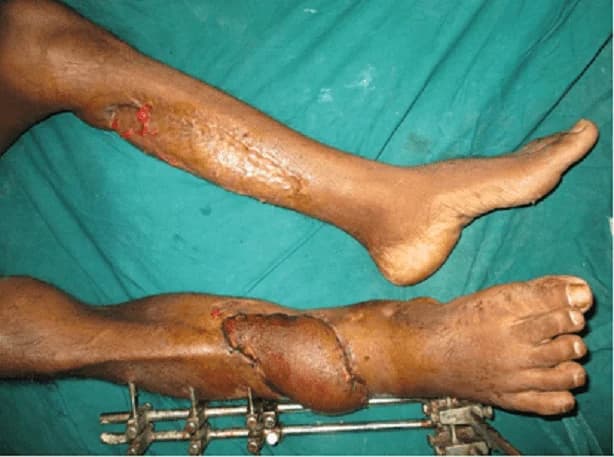 Leg reconstruction around an external fixator, after