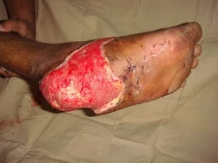 Heel reconstruction with an island flap, before