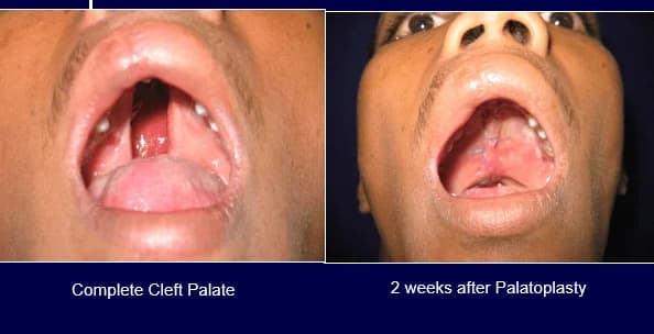 Complete cleft palate: palatoplasty, Complete cleft palate · 2 weeks after palatoplasty