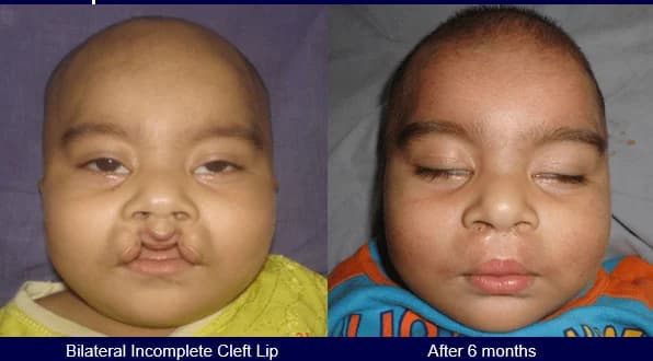 Bilateral incomplete cleft lip repair, Before · 6 months after
