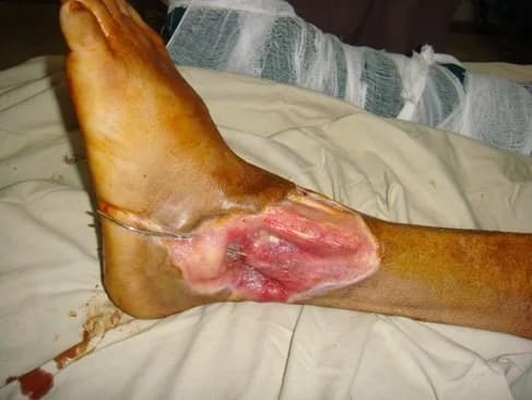 Ankle wound reconstruction, before