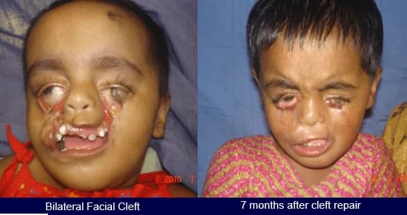 Bilateral facial cleft repair, Before · 7 months after cleft repair