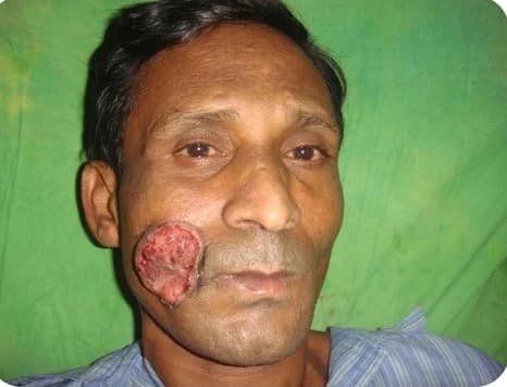 Cheek reconstruction after lesion removal, before
