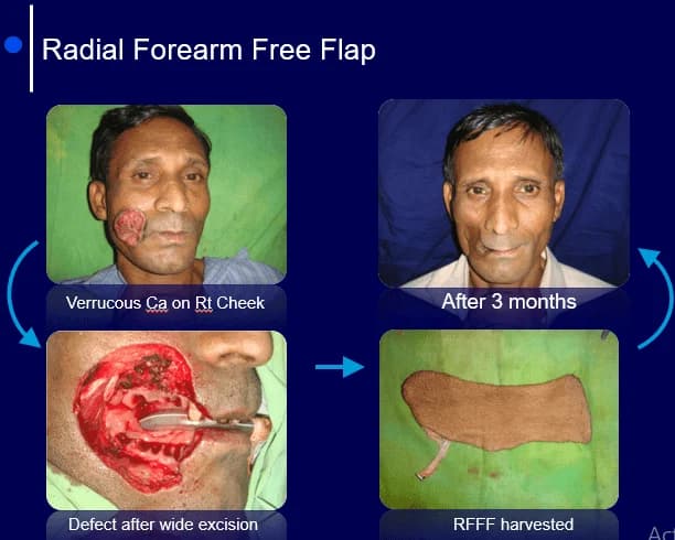 Radial forearm free flap for the cheek, Defect, flap harvest and result at 3 months