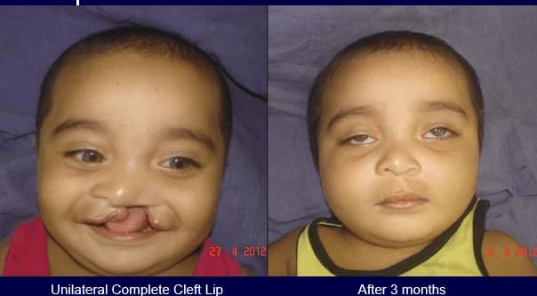 Cleft lip before and after repair