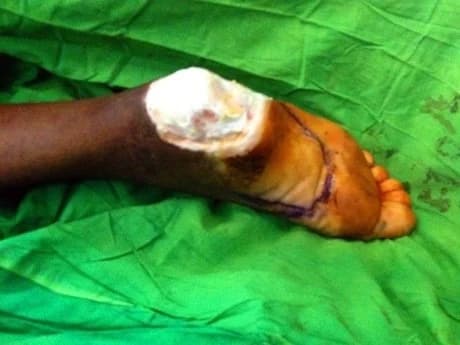 Medial plantar flap for the foot, After surgery