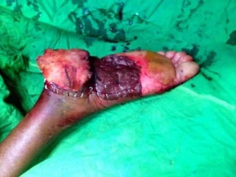 Medial plantar flap for the foot, During surgery