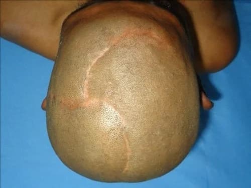 Scalp reconstruction, after