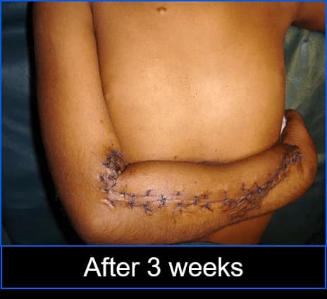 Forearm cover with an abdominal flap, Abdominal flap stage