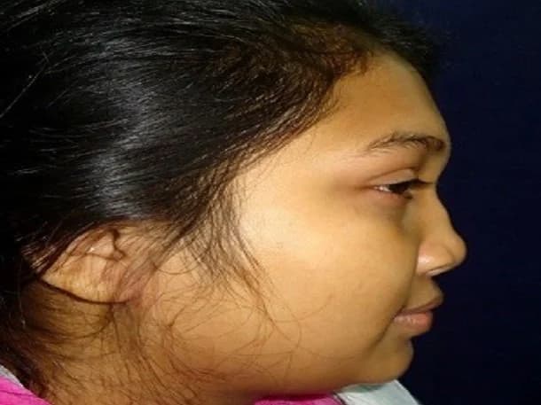 Facial scar revision, after