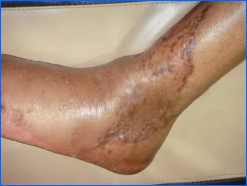 Ankle wound reconstruction, after