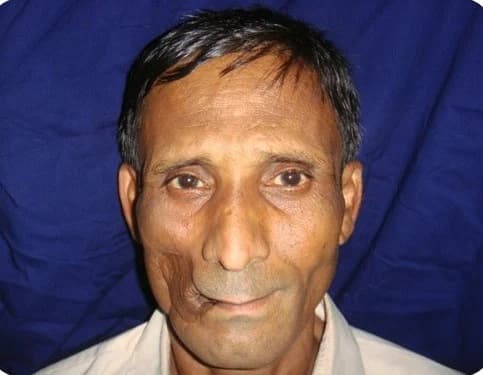 Healed cheek after reconstruction