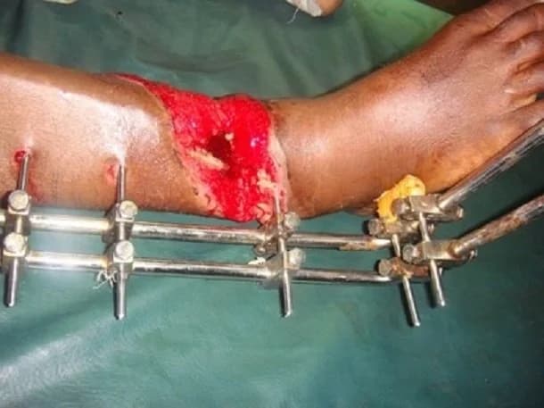 Leg reconstruction around an external fixator, before