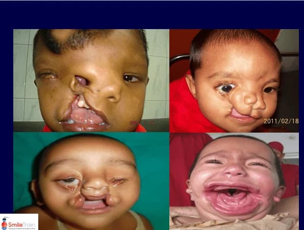 Bilateral cleft lip before and after repair