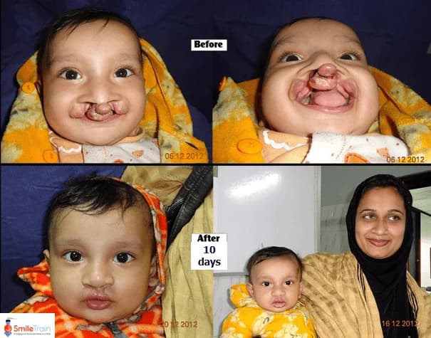 Cleft lip repair, early result, Before · 10 days after