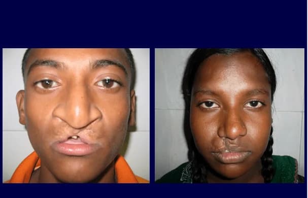 Cleft lip repair in an adult, Before and after repair