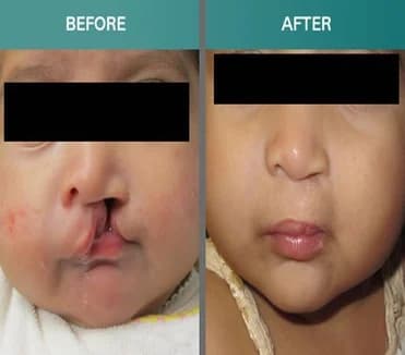 Cleft lip and palate, Before · After